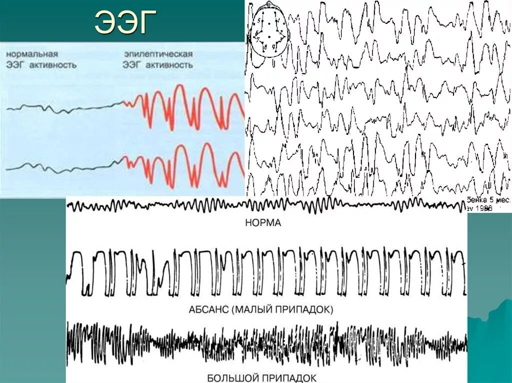 Как выглядит ээг. Паттерн абсанса на ЭЭГ. Эпилептический припадок на ЭЭГ. Абсанс эпилепсия ЭЭГ. Абсансная активность на ЭЭГ.