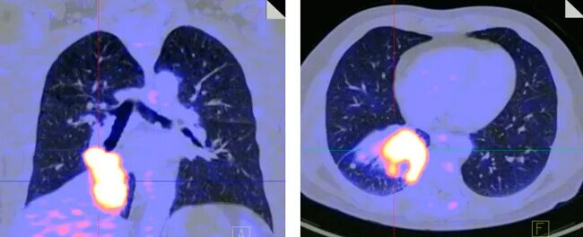 Кт 4 легкие. Позитронно-эмиссионная томография метастазы. Позитронно эмиссионная томография онкология. Позитронно-эмиссионная томография желудка. ПЭТ кт метастазы в легких.