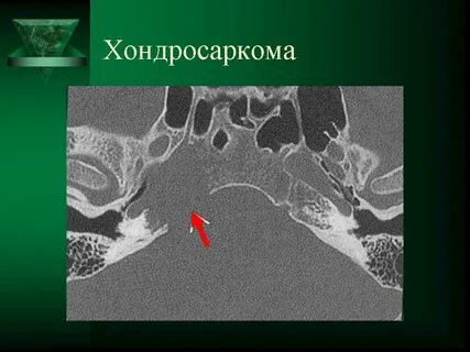 Опухоль височно