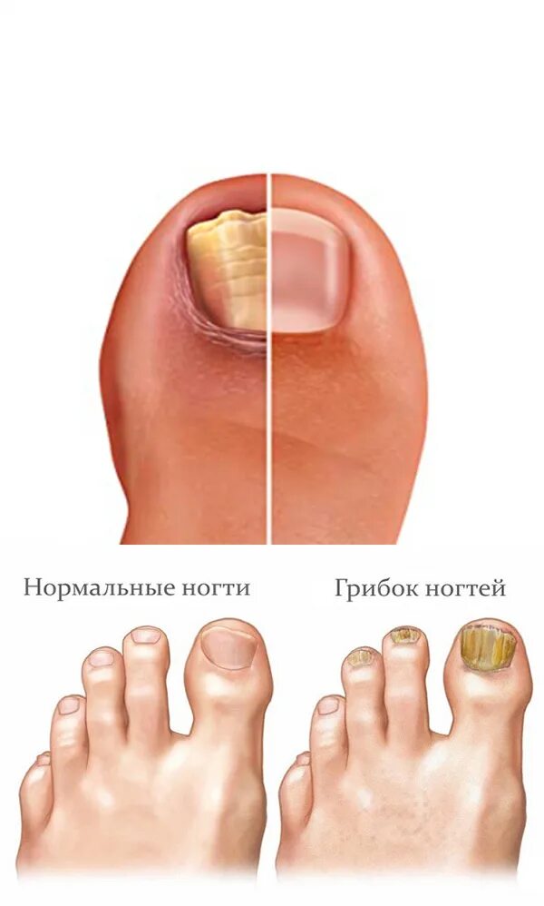 Ногти на ногах стали
