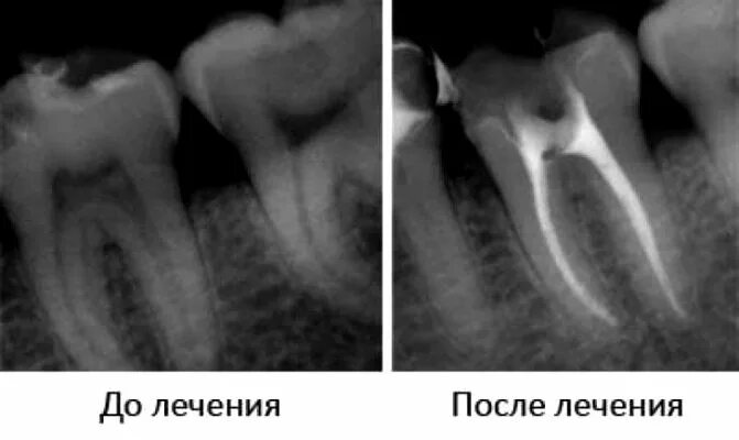 Временное лечение каналов зуба. Периодонтит рентген снимок. Гранулирующий апикальный периодонтит.