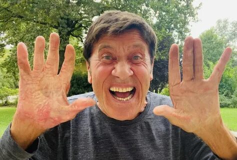 Gianni Morandi mostra la mano ustionata un anno e mezzo dopo l’incidente: &...