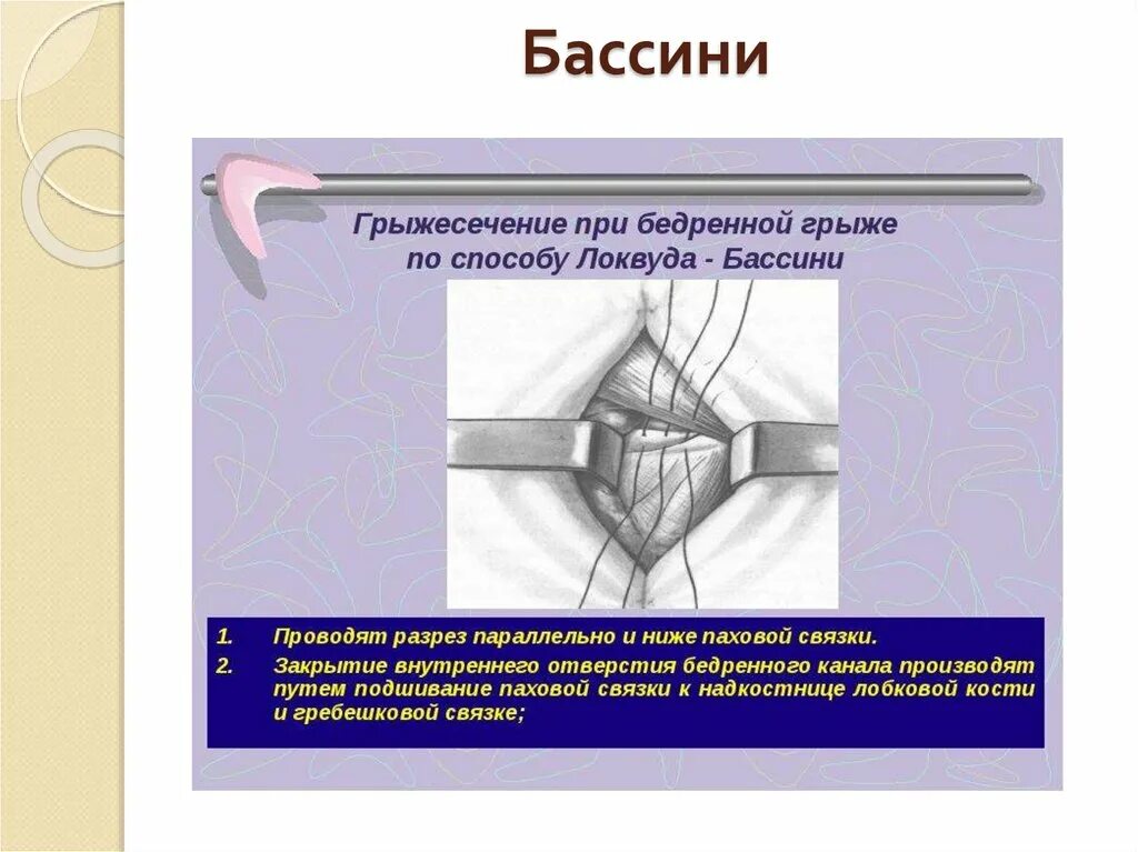 Ущемленная бедренная грыжа. Бедренная грыжа метод Бассини. Операция Бассини при бедренных грыжах. Метод Бассини при бедренной грыже. Операция по Бассини при бедренной грыже.