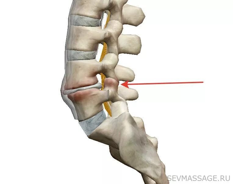 При защемлении нерва пояснице какие. Защемление Корешков позвоночника. Защемление поясничного нерва. Ущемление нервных Корешков поясничного. Защемление поясничного позвонка.