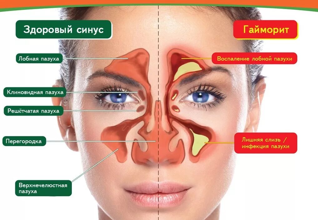 Строение гайморовых пазух. Строение носа и гайморовых пазух. Носовые пазухи, переносица строение. Как лечить дома гайморит быстрые и эффективные