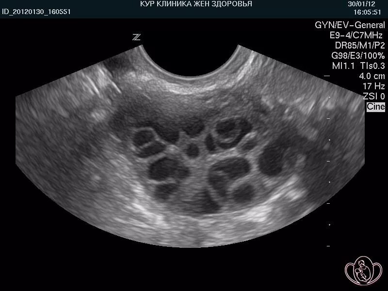 УЗИ яичников доминантный фолликул. Фолликулометрия УЗИ доминантный фолликул. Мультифолликулярные яичники на УЗИ.