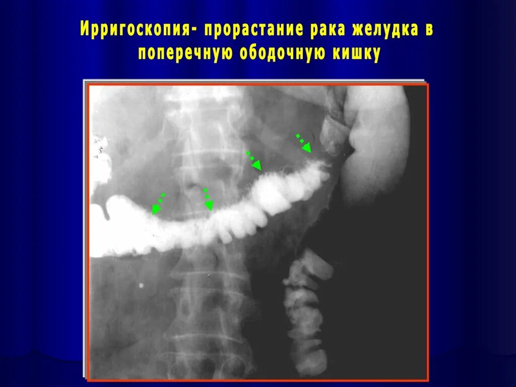 Ирригоскопия с двойным контрастированием. Ирригоскопия с двойным контрастированием