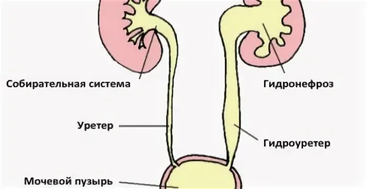 Гидронефроз симптомы у взрослых. Стадии гидронефроза почки.