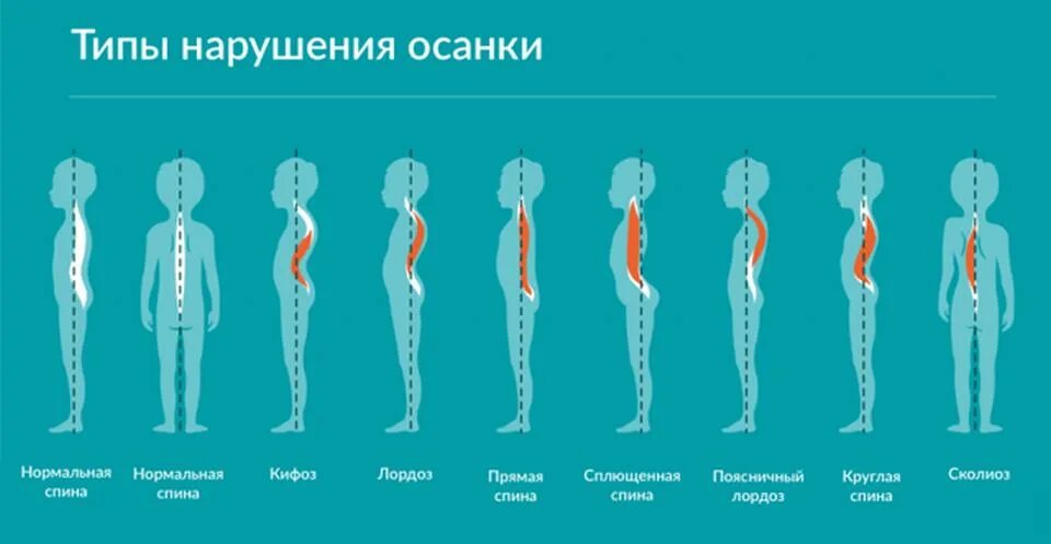 Типы неправильной осанки. «предупреждение нарушения осанки у детей». Классификация нарушений осанки. Различные нарушения осанки. Различные нарушения осанки.