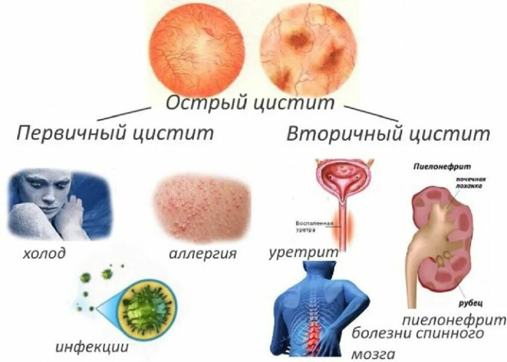 Какой болезни цистит