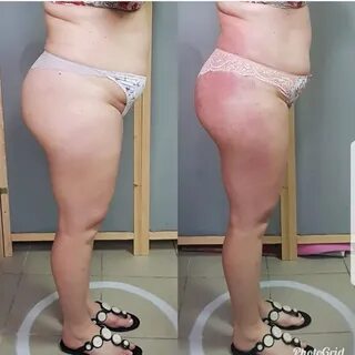 Массаж тела гуаша схема антицеллюлитный
