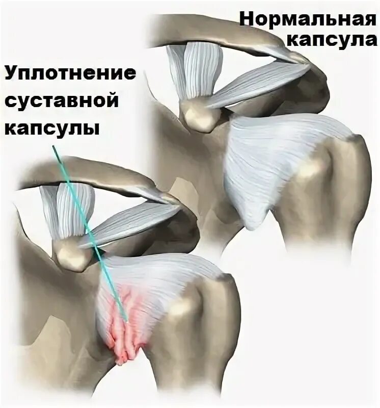 Адгезивный капсулит плечевого сустава симптомы. Ретрактильный капсулит плечевого сустава. Воспаление суставной капсулы плечевого сустава.