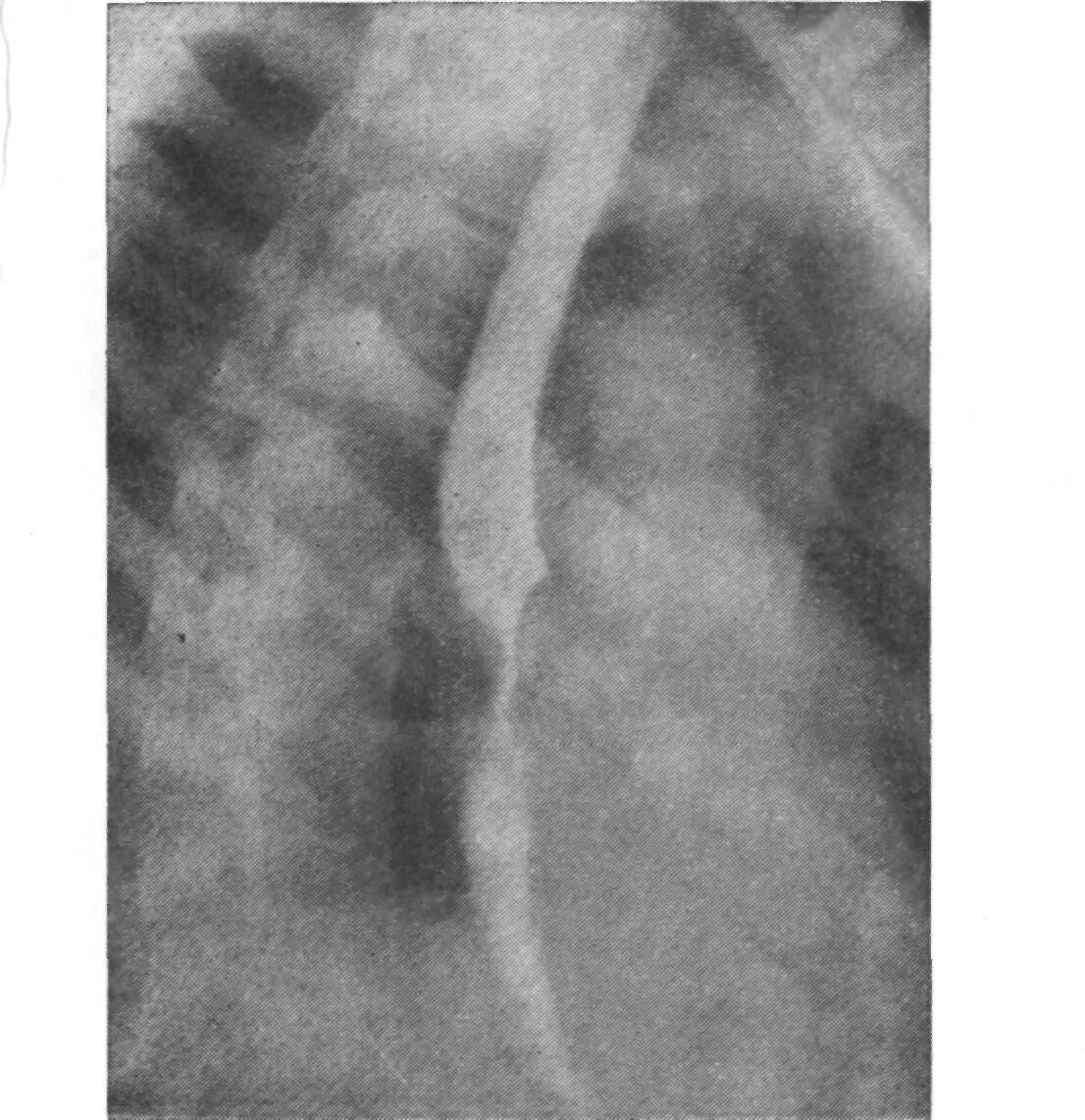 Лейомиома пищевода рентген. Лейомиома пищевода рентгенограмма. Постстенотическое расширение пищевода. Обзорная рентгенография пищевода.