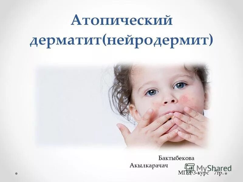 Атопический дерматит профилактика. Атопический дерматит презентация. Атопия определение. Атопического дерматита презентация. Атопический дерматит клинические рекомендации 2020.