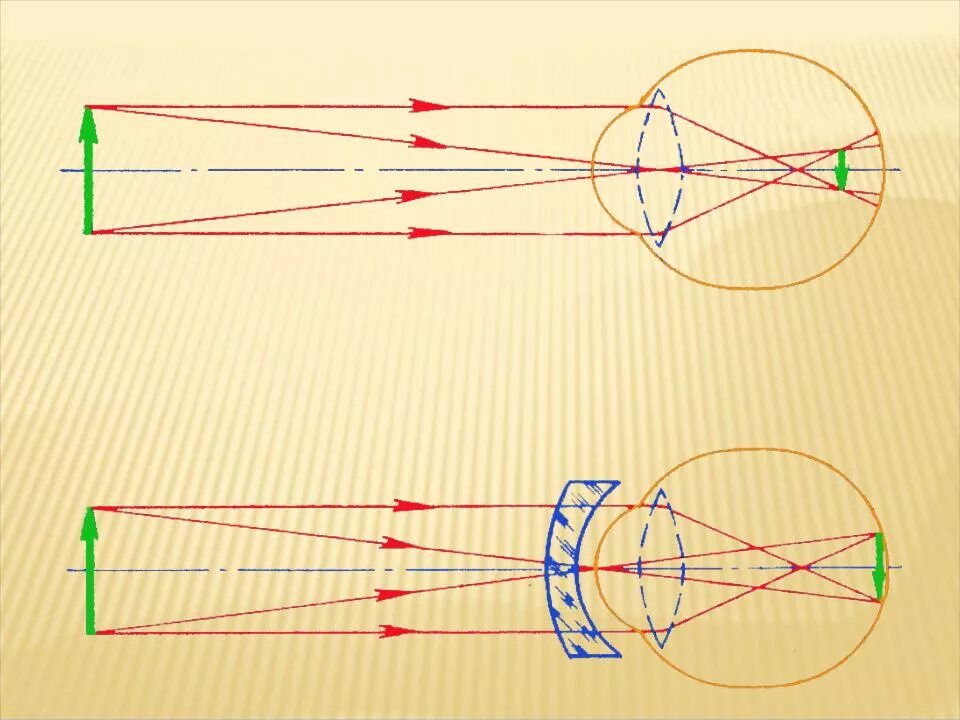 Ход лучей глаза человека. Ход лучей в глазу при эмметропии. Близорукий глаз ход лучей физика. Дальнозоркость схема хода лучей. Близорукость схема лучей.