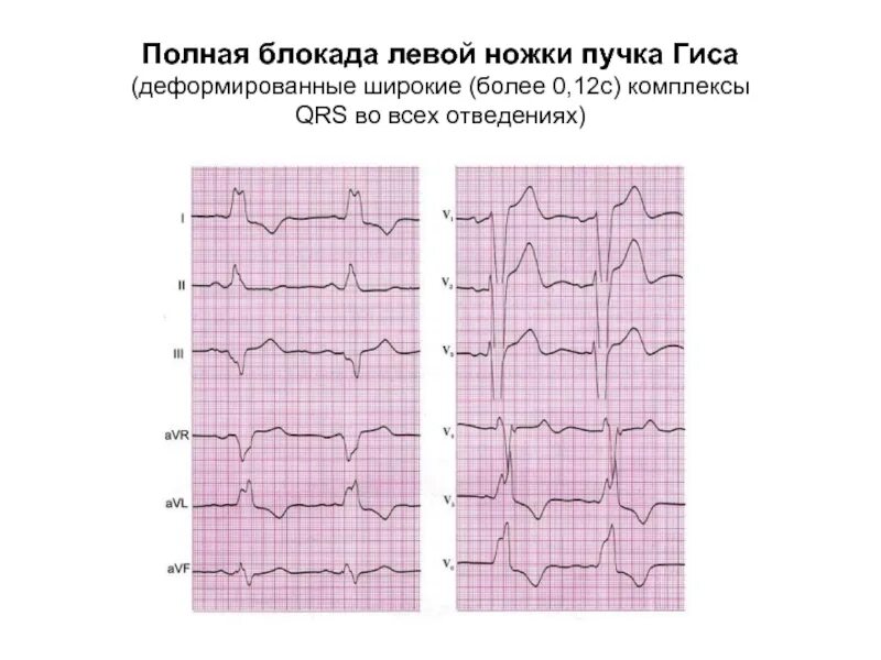 Блокада левой ножки пучка Гиса на ЭКГ. Полная блокада левой ножки пучка Гиса на ЭКГ. Блокада ЛНПГ на ЭКГ. ЭКГ критерии полной блокады левой ножки пучка Гиса. Левая ножка п гиса