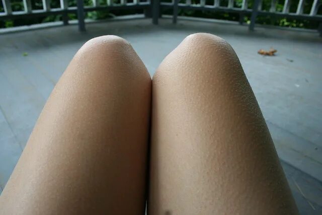 Причины мурашек по телу. Фолликулярный фолликулярный гиперкератоз. Keratosis pilaris (фолликулярный гиперкератоз). Гусиная кожа на ногах девушек. Гусиные ноги у девушек.