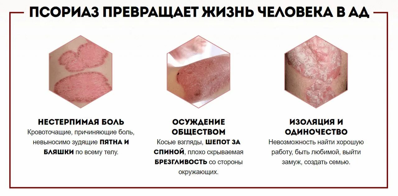 Оптидермал отзывы. Осложнения от псориаза. Эритродермический псориаз.