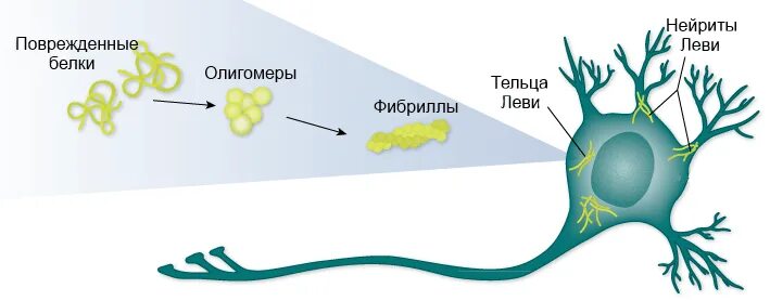 патоморфология деменция с тельцами леви. болезнь телец леви. болезнь альцгеймера с тельцами леви. болезнь альцгеймера и деменция с тельцами леви. деменция с тельцами левина.