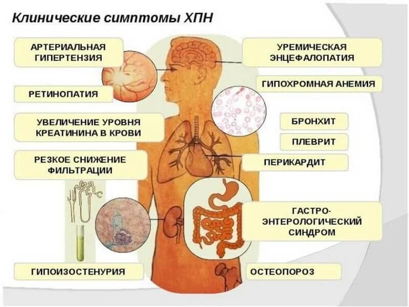 Клинические симптомы ХПН. Основные клинические проявления почечной недостаточности:. Уремический синдром хроническая почечная недостаточность. Клинические симптомы хронической почечной недостаточности.