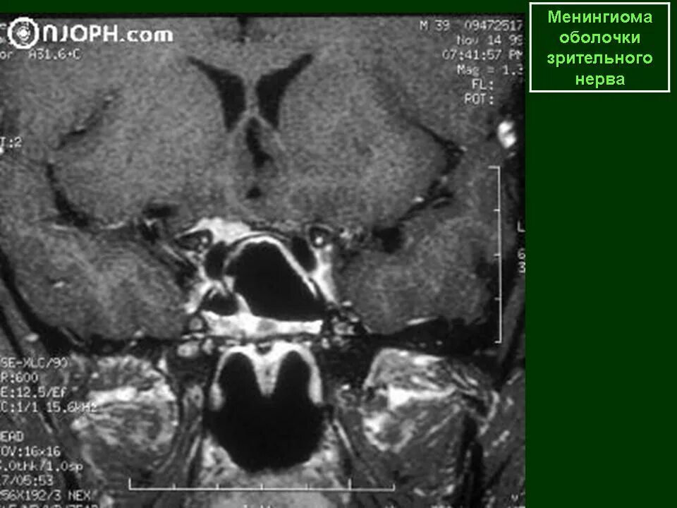 Менингиома зрительного нерва мрт. Менингиома мкб. Менингиома около глазного нерва. Менингиома зрительного нерва клинические рекомендации.