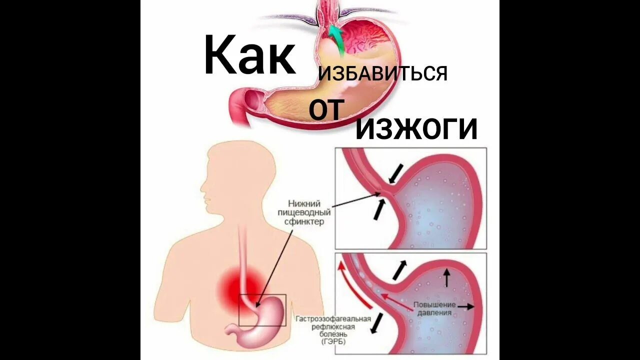 Как избавиться от изжоги при беременности. Как избавиться от изжоги при беременности