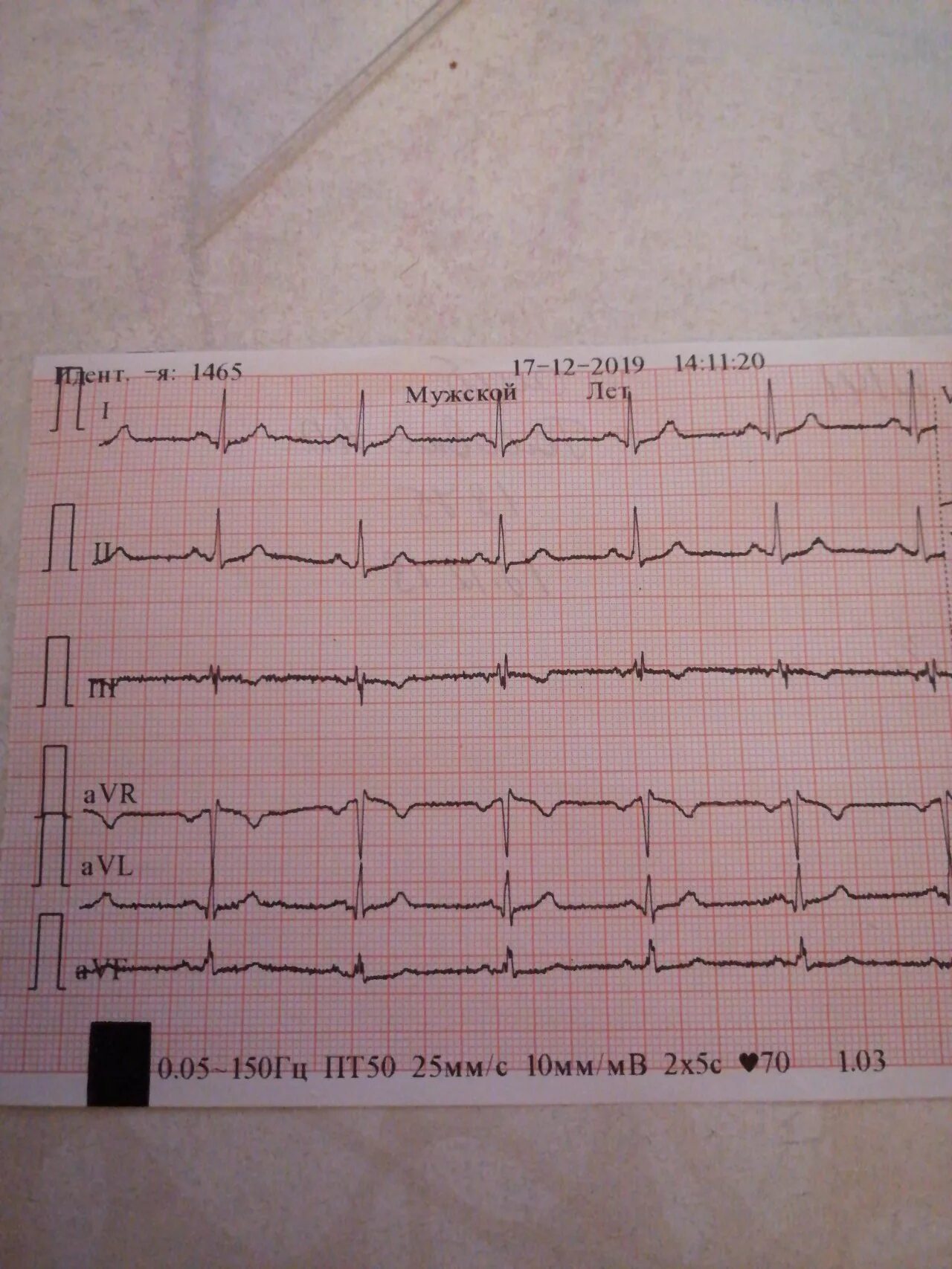 Нормальная лента экг. Синусовый или несинусовый ритм. Тахикардия вертикальная эос. Тахикардия вертикальная эос. Экг при тахикардии расшифровка.