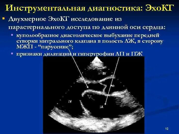 Митральный стеноз на узи сердца. Митральный клапан эхокг. Митральный клапан на эхокг. Аортальный стеноз допплер эхокг. Пролапс митрального клапана на узи.