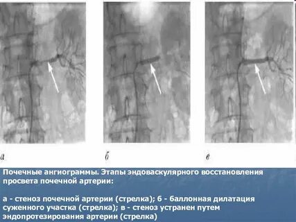 Почечная артерия операция