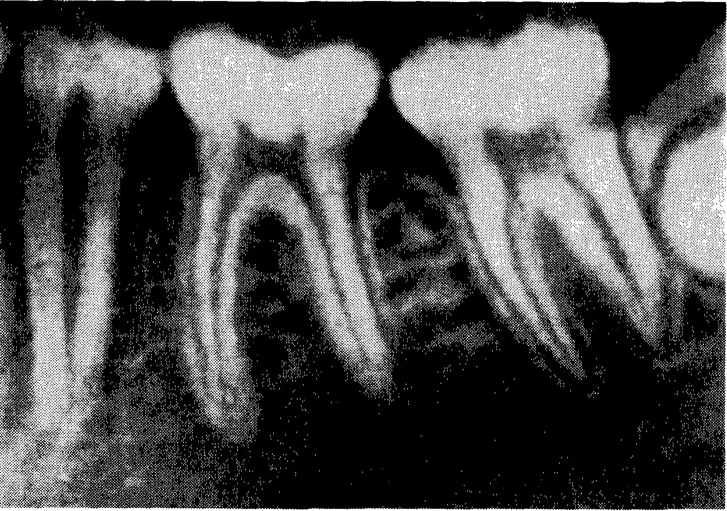 периодонтальная щель зуба