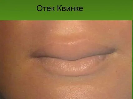 5 месяцев отеки