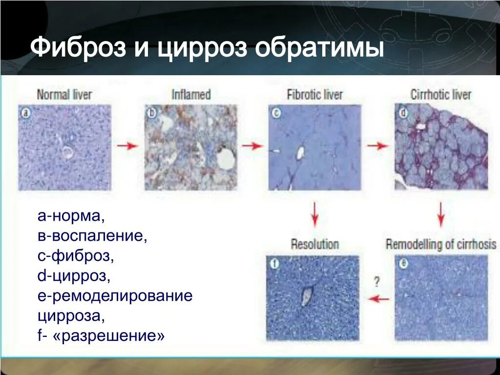 Фиброз печени лабораторная диагностика. Стадии фиброза.