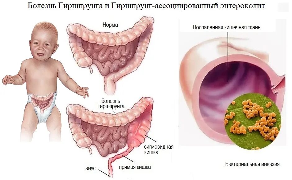 Болезнь Гиршпрунга этиология. Мегаколон болезнь Гиршпрунга. Врождённый мегаколон (болезнь Гиршпрунга. Болезнь Гиршпрунга этиология патогенез. Тонкая кишка ребенка