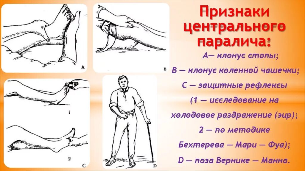 Почему парализует ноги. Клонус коленной чашечки. Клонусы стоп и коленных чашечек. Клонусы коленной чашечки и стопы. Клонусы стоп и надколенников.