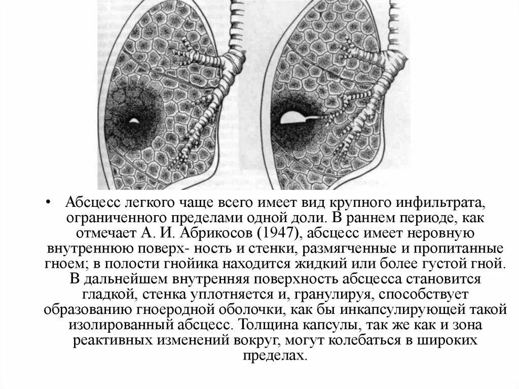 Дренированный абсцесс легкого. Первая фаза клинического течения абсцесса легкого. Гнойное расплавление лёгочной ткани. Исследования при абсцессе легкого. 1 абсцесс легкого