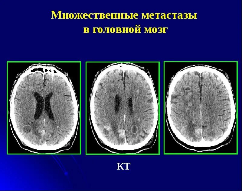 Метастаза головного мозга 4 стадия. Метастазы головного мозга кт кт. опухоли головного мозга кт снимки. опухоль головного мозга метастазы.