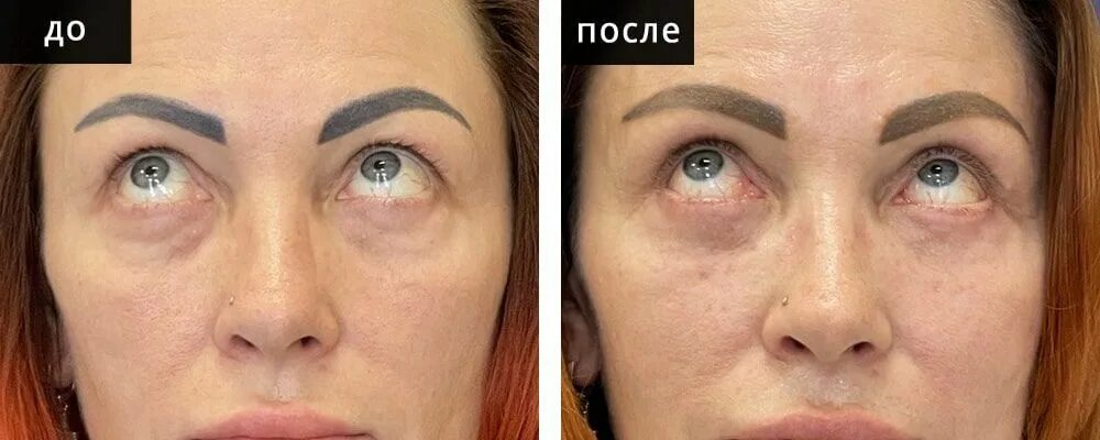 Кантопексия фото до и после операции Что такое кантопексия. Для чего проводится кантопексия. Омоложение глаз методом