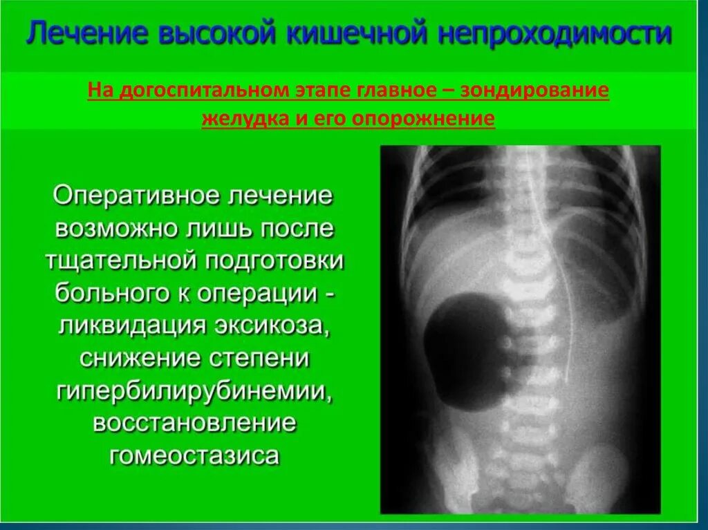 Кишечная непроходимость. Острая непроходимость кишечника. Симптомы высокой непроходимости. Непроходимость пищеварительного тракта.