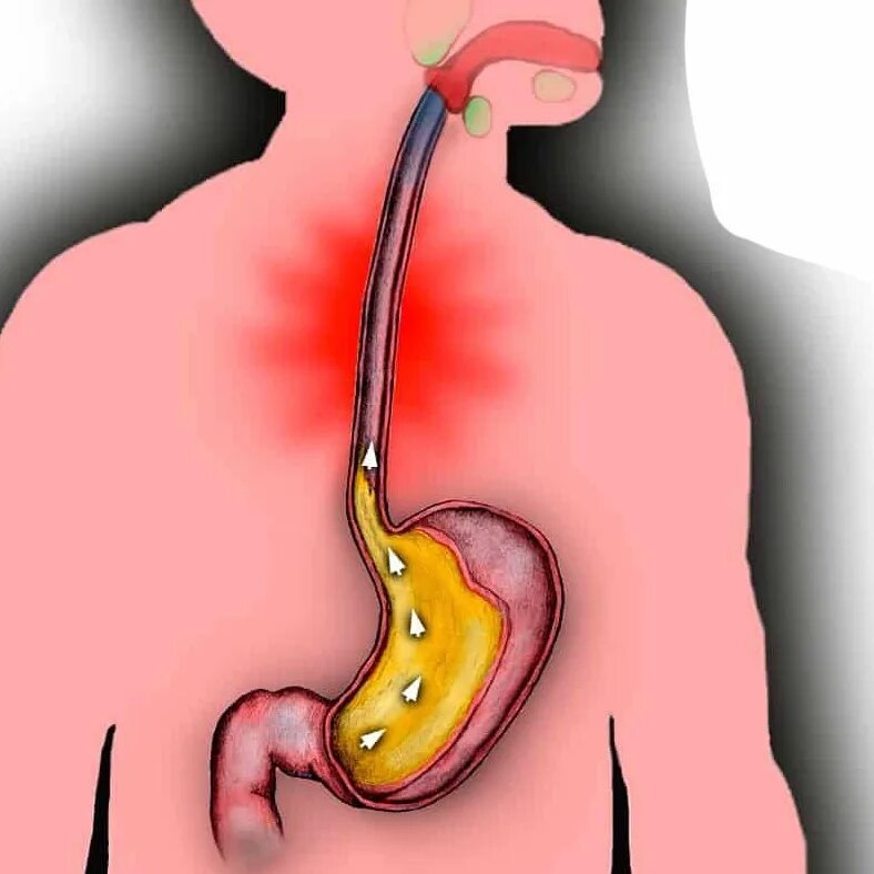 Пищевод у детей. Язвенный рефлюкс эзофагит. Внепищеводный рефлюкс эзофагит. Забрасывание содержимого желудка в пищевод:.