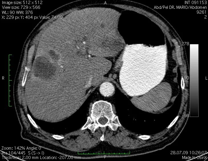 Кт мрт механическая желтуха. Компьютерная томография (кт) с контрастированием, печени. Крупноузловой цирроз печени на кт. Магнитно-резонансная томография печени. Кт гепатобластома печени.