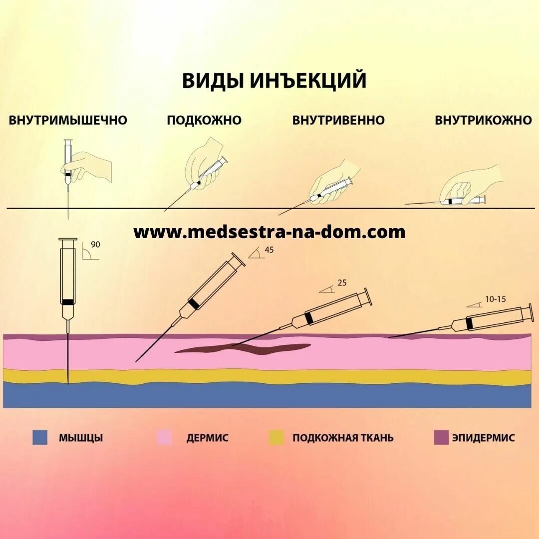 Подкожная глубина введения иглы. Инъекции внутримышечно внутривенно подкожно. Углы введения инъекций. Внутрикожная инъекция угол введения. Внутримышечная внутривенная подкожная внутрикожная инъекция.