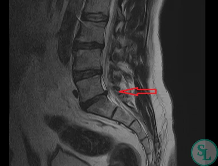 Остеохондроз поясничного отдела l5 s1. Грыжа l5-s1. Грыжа l5-s1 упражнения. Грыжа диска l5-s1. Межпозвонковый диск l5-s1.
