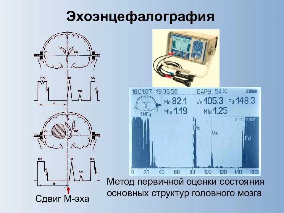 Эхо гостомеля. Эхоэнцефалография. Эхоэнцефалография метод. Одномерная эхоэнцефалография. Эхоэнцефалоскопия методика.