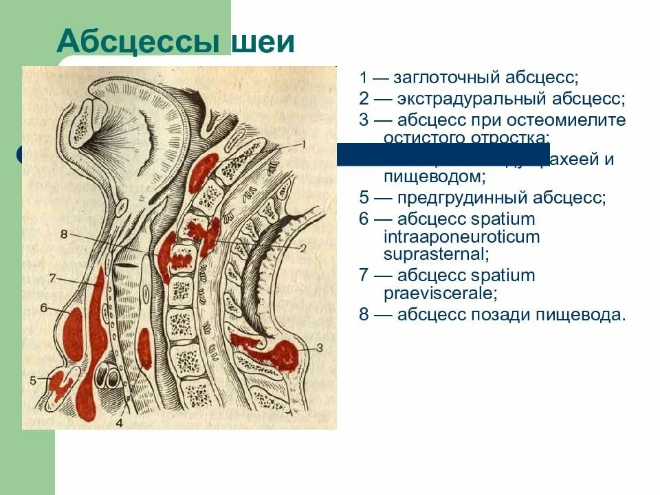 Лимфоузлы пищевода. Воспаление заглоточного пространства. Ретрофарингеальный абсцесс.