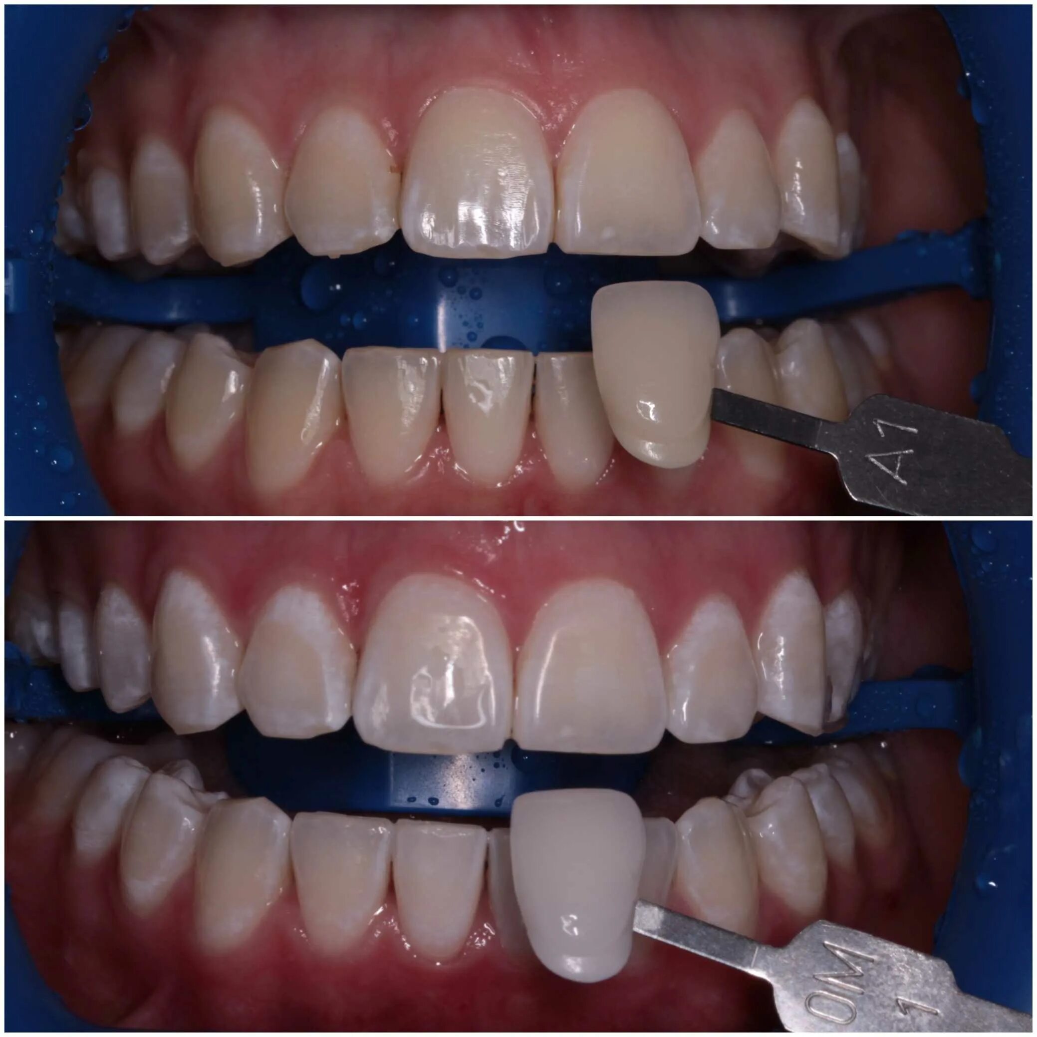 Зуб отбеливание пить. Отбеливание зубов. Стоматология отбеливание. Отбеливание зубов в стоматологии. Фотоотбеливание зубов.