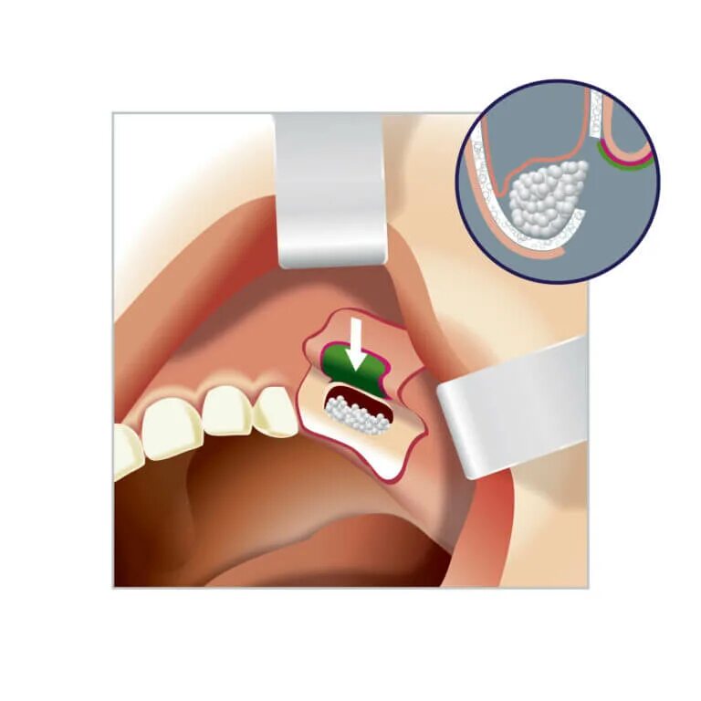 пластика после удаления зуба. лоскутная операция пародонтальных карманов. пластика после удаления зуба. Bone graft костный трансплантат. пластика после удаления зуба.