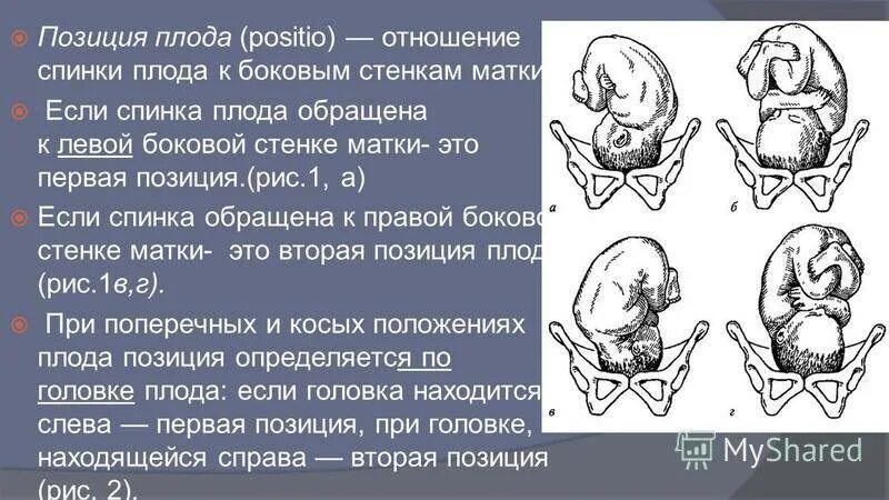 Позиция плода в акушерстве. Головное предлежание плода первая позиция передний вид. Продольное положение плода положение плода головное. Тазовое предлежание 1 позиция передний вид. Продольное головное предлежание плода 2 позиция передний вид.