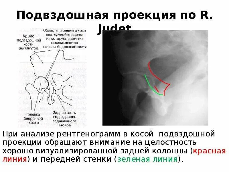 Образование подвздошной кости. Рентгенограмма таза в косой проекции. Остеомиелит подвздошной кости. Рентгенологическая косая подвздошная проекция.