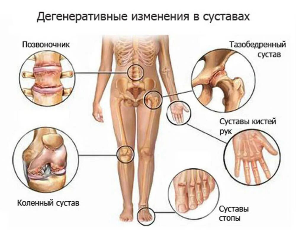 Какие бывают болезни суставов. Суставы.