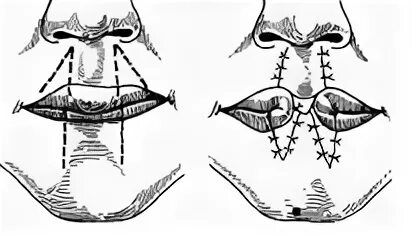 Операция нижней губы. Клиновидная резекция нижней губы. Пластика губы по Брунсу. Пластика нижней губы по Диффенбаху. Пластика нижней губы по Брунсу.